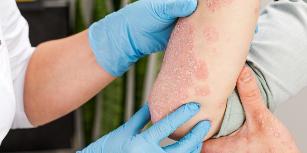 Pacientes con psoriasis