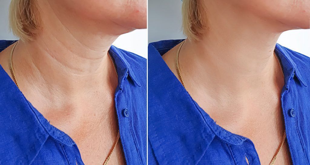 Lifting de cuello