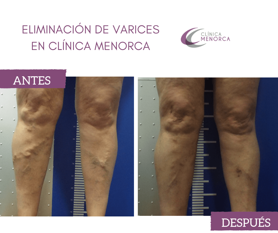 antes y después varices