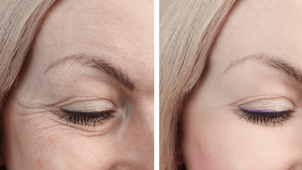 Blefaroplastia. Cirugía