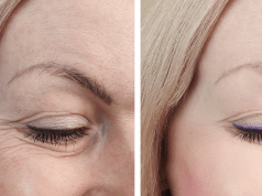 Blefaroplastia, la cirugía más demandada en mujeres mayores de 50 años Blefaroplastia. Cirugía