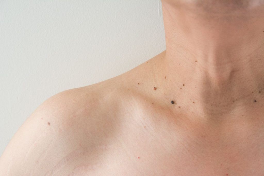 Verrugas en el cuello