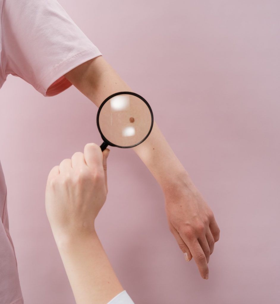 Melanoma