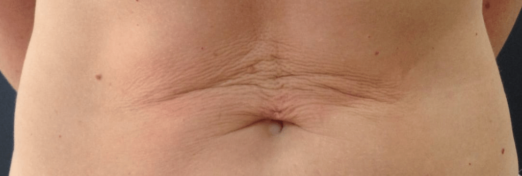 la laxitud cutánea abdomen