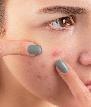 Dermatilomania