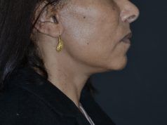 Rejuvenecimiento facial y cirugía plástica rejuvenecimiento facial