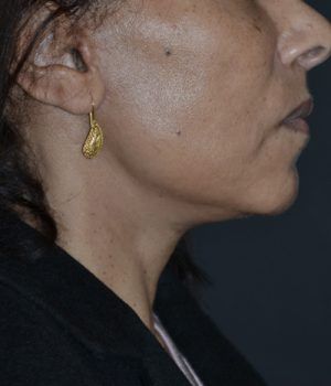 rejuvenecimiento facial