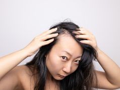 Alopecia frontal fibrosante en la mujer La Alopecia frontal fibrosante