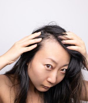 La Alopecia frontal fibrosante La Alopecia frontal fibrosante