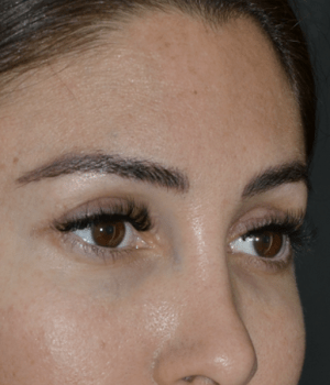 estiramiento de cejas con cantopexia lateral estiramiento de cejas con cantopexia lateral