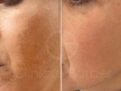 Cuidados del melasma en verano melasma