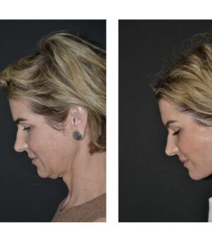 Lifting facial