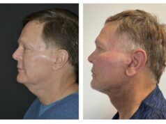 Rejuvenecimiento facial para hombres rejuvenecimiento-facial-DR.-AHMAD-SAAD