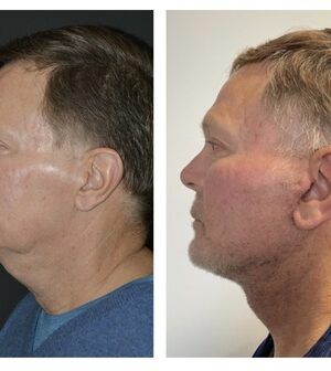 rejuvenecimiento-facial-DR.-AHMAD-SAAD rejuvenecimiento-facial-DR.-AHMAD-SAAD