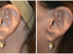 Cicatrices después de un lifting facial lifting facial