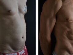Lipoescultura de alta definición para transformar el cuerpo lipoescultura de alta definición