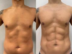 Radiofrecuencia bipolar para conseguir un abdomen definido Radiofrecuencia bipolar