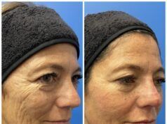 Bioestimuladores con efecto lifting bioestimuladores