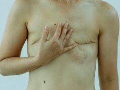 Implante para la reconstrucción de areola-pezón tras mastectomía Reconstrucción areola-pezón