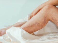 Arañas vasculares y varices, más que un problema estético varices