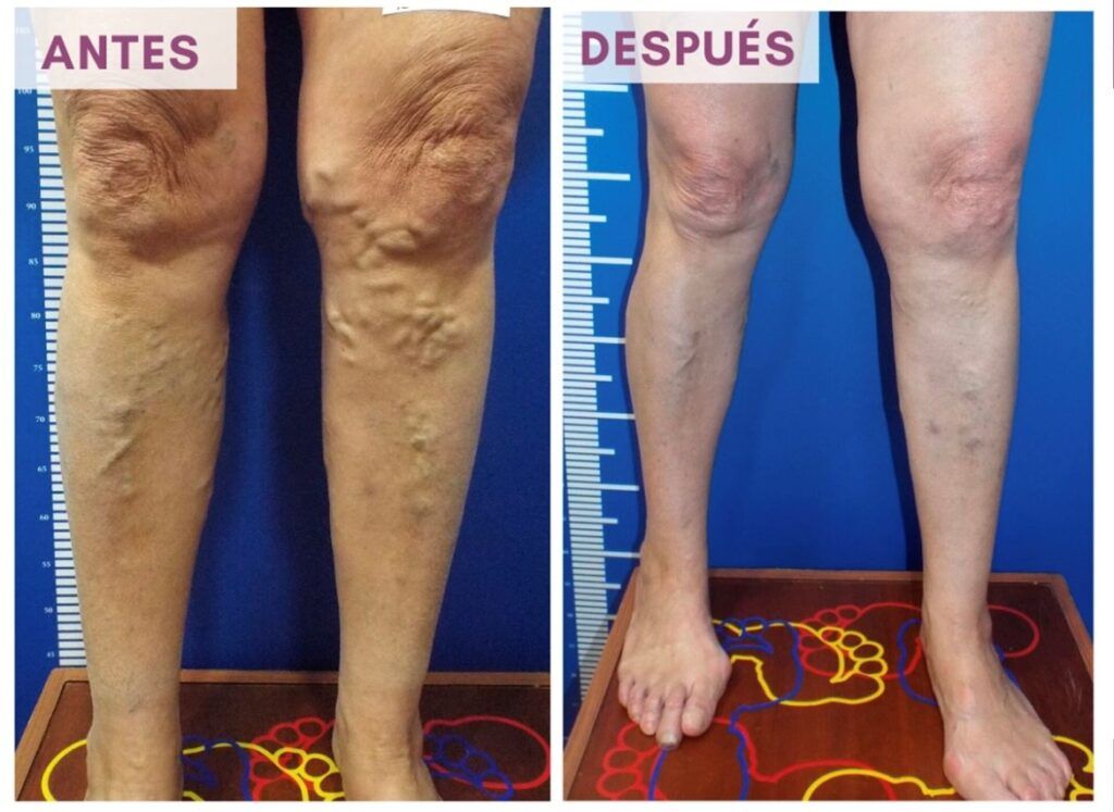 eliminar las varices