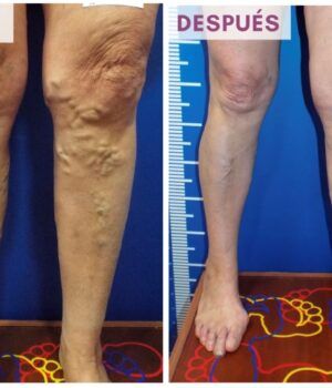 eliminar las varices